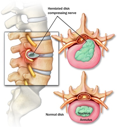 Acute Lumbar Disc Herniation