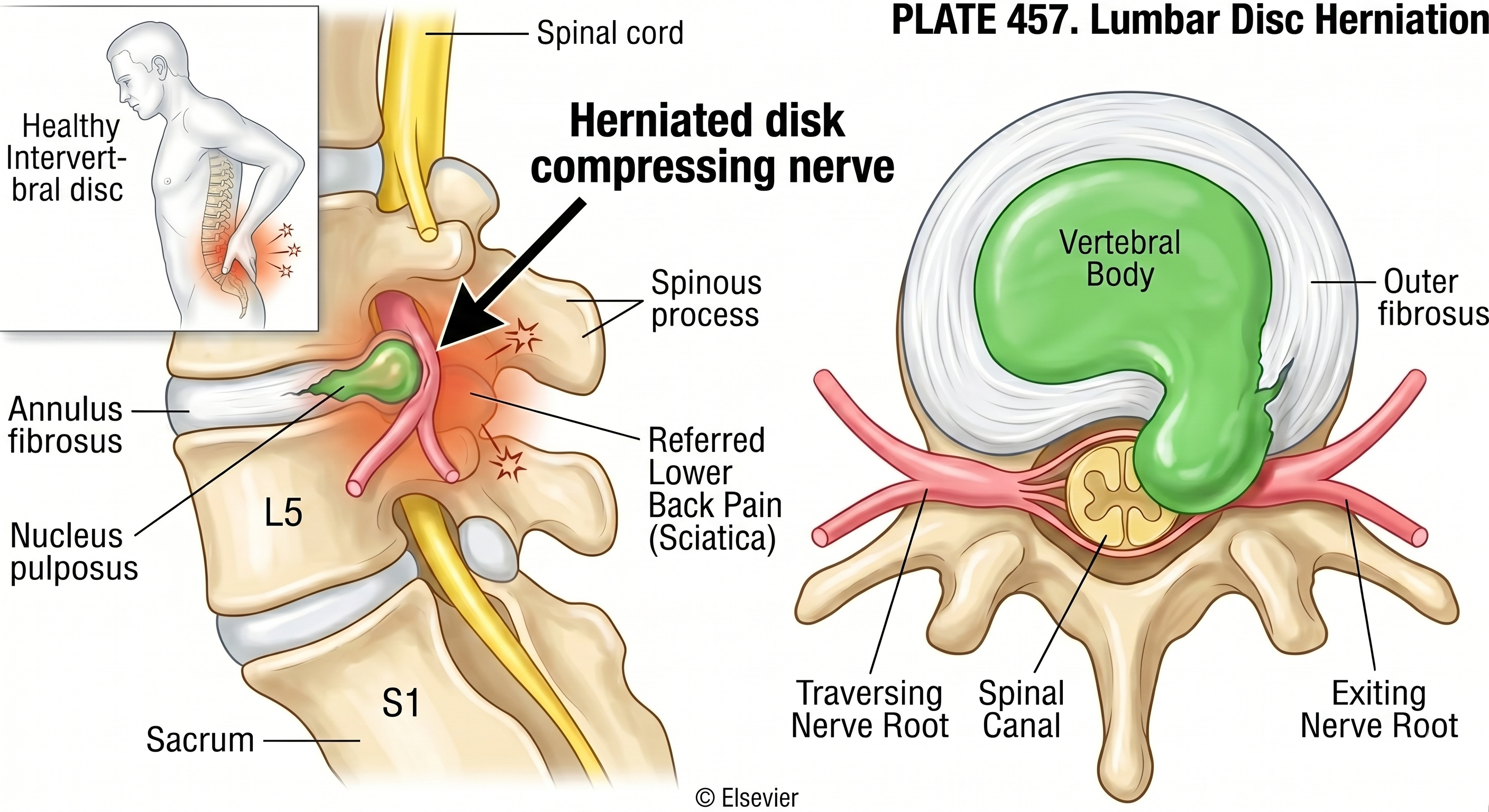 Acute Lumbar Disc Herniation: What It Is, When to Worry, and How We Can Help